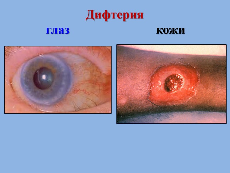 Клинические формы дифтерии Дифтерия ротоглотки (зева) Дифтерийный круп: дифтерия гортани (дифтерийный круп локализованный); дифтерия