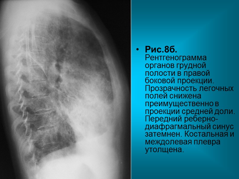 Пациент С. 59л. Диагноз: Периферический бронхиолоальвеолярный рак, диссеминированная (диффузная) форма.  Рис.4а. Рентгенограмма органов