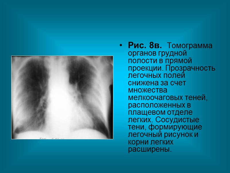 Рис.4б. Рентгенограмма органов грудной полости в прямой проекции. Прозрачность обоих легочных полей негомогенно интенсивно