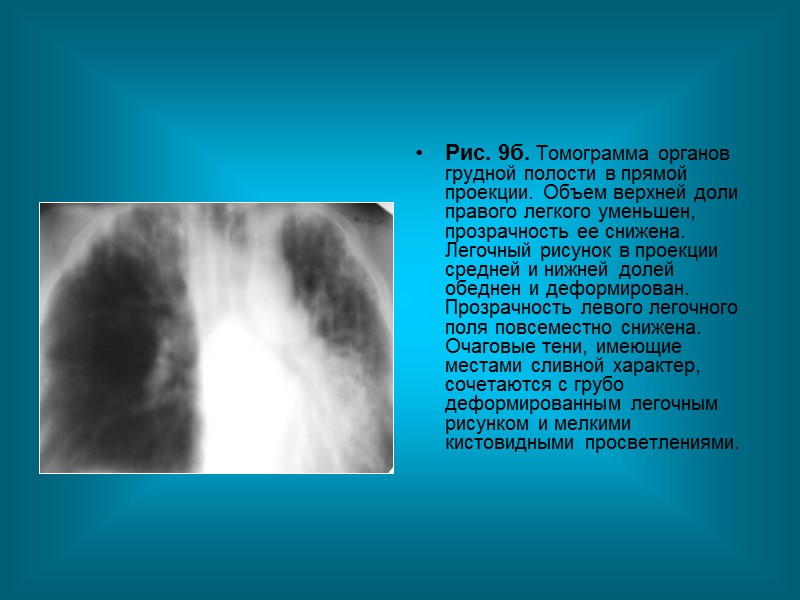 Пациент Ц. 56л  Диагноз: Хроническая пневмония, Хронический абсцесс нижней доли левого легкого. 