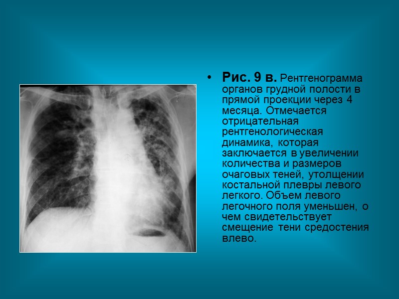 Рис. 5б. Рентгенограмма органов грудной полости в левой боковой проекции. Кольцевидная тень проецируется на