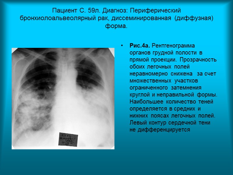 Пациентка К. 70 л. Диагноз: Диссеминированный туберкулез легких. Бронхогенная диссеминация.  Рис.1. Обзорная рентгенограмма