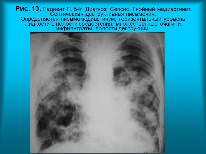 Н.С. Во Рис.8б.  Рентгенограмма органов грудной полости в правой боковой проекции. Прозрачность легочных