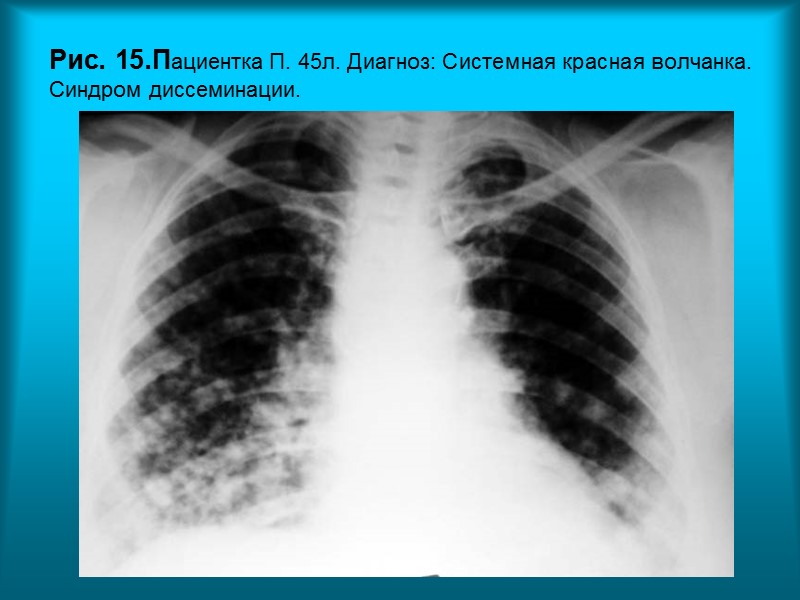 Пациент П. 42г Диагноз: Фиброзирующий альвеолит. Анамнез заболевания -  7 лет.  