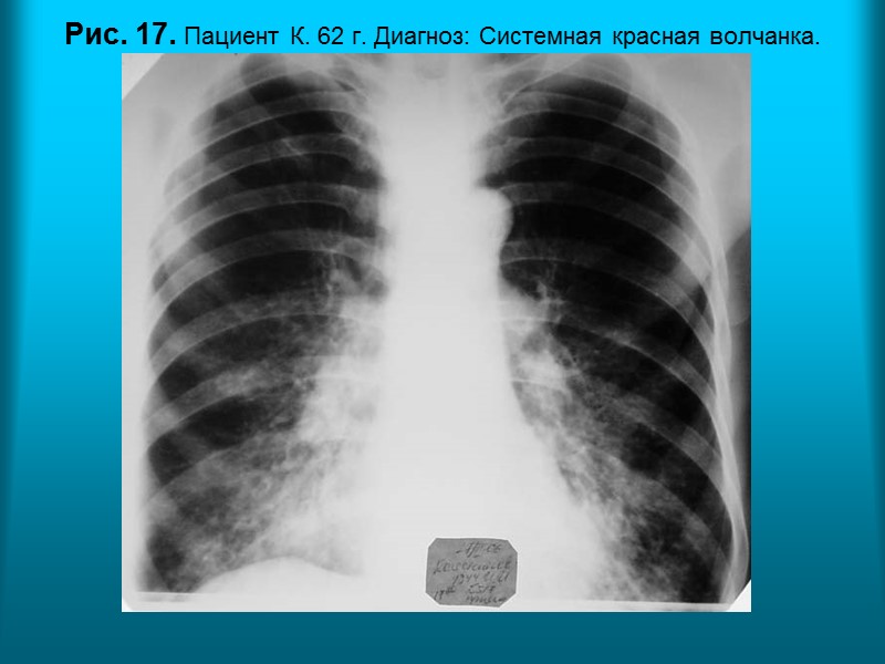 Рис. 9 в. Рентгенограмма органов грудной полости в прямой проекции через 4 месяца. Отмечается