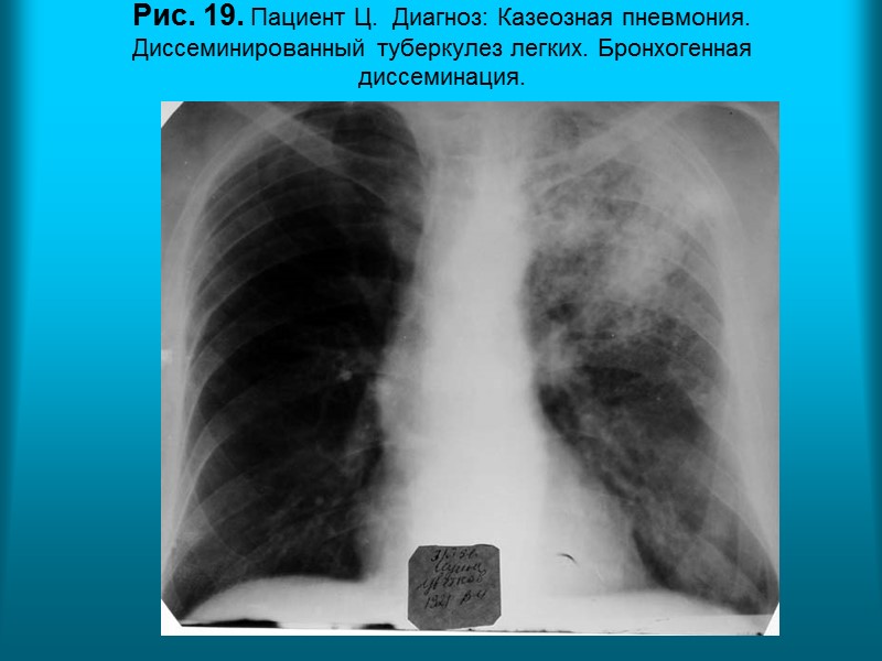 Рис.11б.  Рентгенограмма органов грудной полости в прямой проекции. Отрицательная динамика: массивный смешанный (интерстициальный