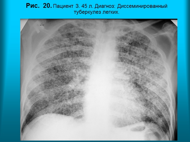 Пациентка Б. 28 л.  Диагноз: Системная красная волчанка. Интерстициальный и альвеолярный отек легких.