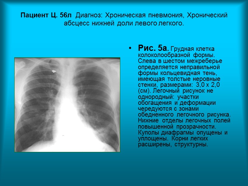 Пациентка З. 55л. Диагноз: Подострый диссеминированный туберкулез легких, фаза инфильтрации. Рис. 2. Рентгенограмма органов