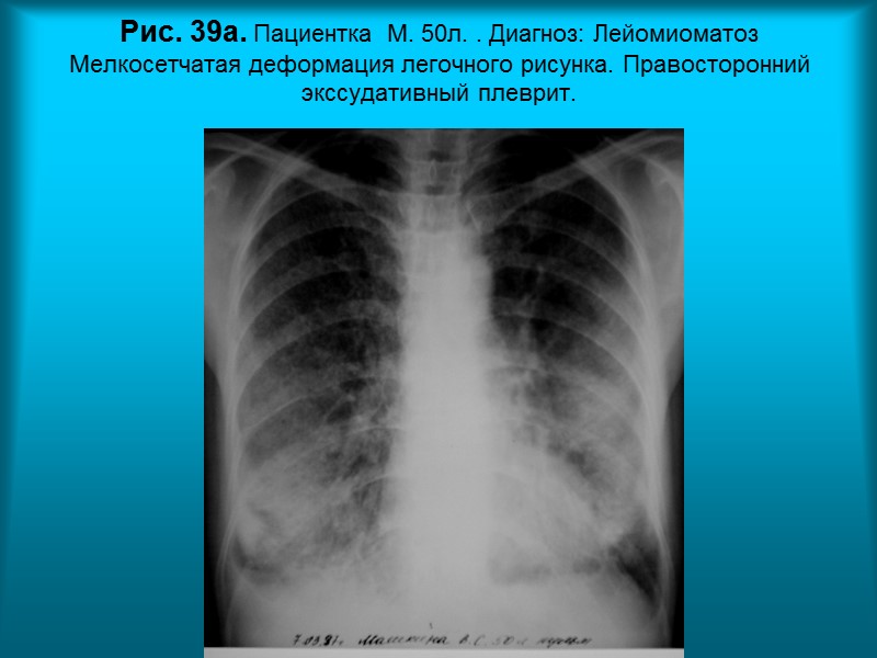 Н.С. Воротынцева. С.С. Гольев  Рентгенопульмонология Рис. 34в. Пациент Ф. 7 мес.  Диагноз: