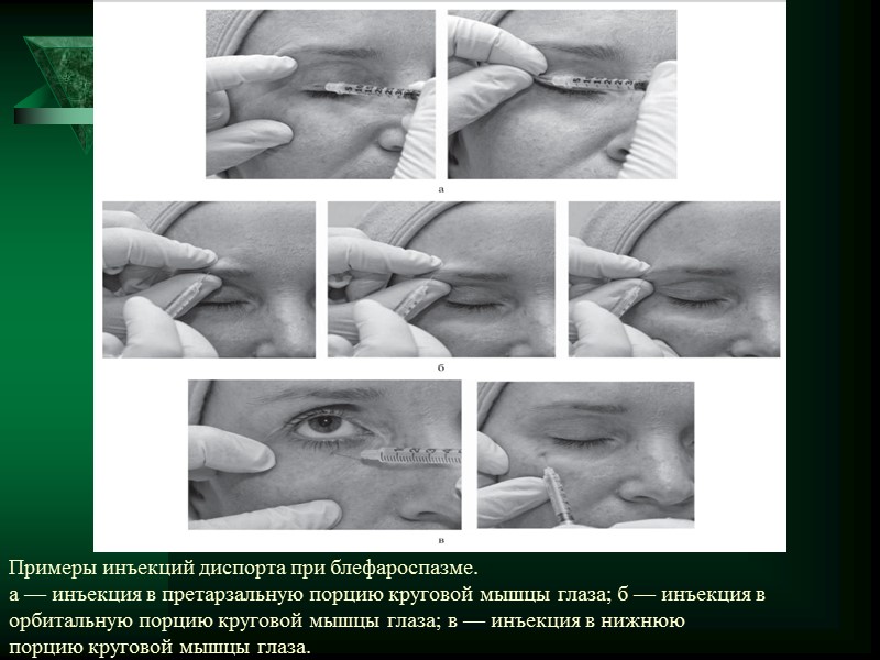 Лицевой гемиспазм-      это односторонний гиперкинетический синдром, наблюдаемый в зоне
