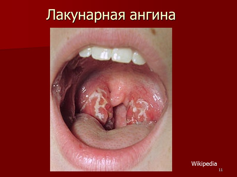 Ангина (тонзиллит) – синдром: Лихорадка Боль в горле     при глотании