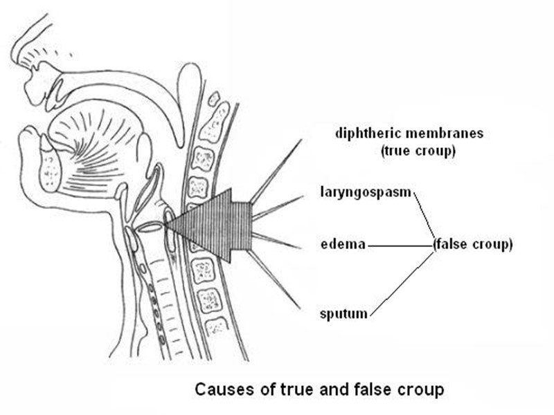 Тяжелая форма дифтерии ротоглотки:  острое начало и высокая лихорадка, сильная головная боль, миалгии