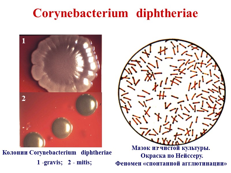 ДИФТЕРИЯ  - острое инфекционное заболевание, вызываемое  токсигенными  штаммами  Corinebacterium 