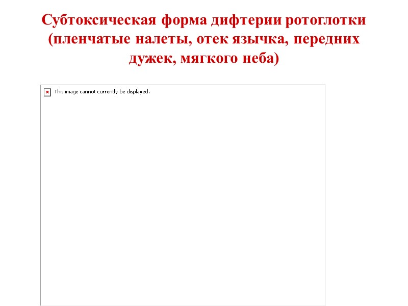 Дифференциальный диагноз локализованной формы дифтерии ротоглотки (продолжение)