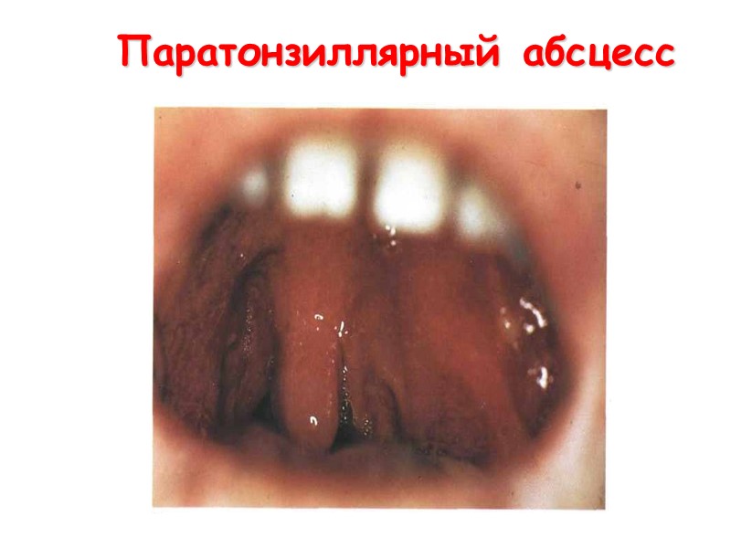 Дифтерия ротоглотки, токсическая форма I степени Отек слизистой ротоглотки: миндалин, дужек, малого язычка