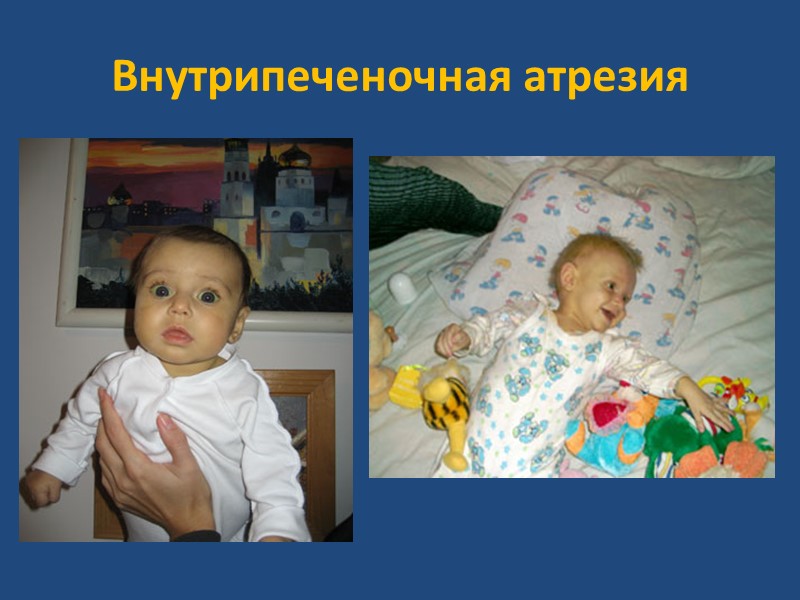 Атрезия внепеченочных желчных протоков  1 случай на  3500 - 20 тысяч новорожденных
