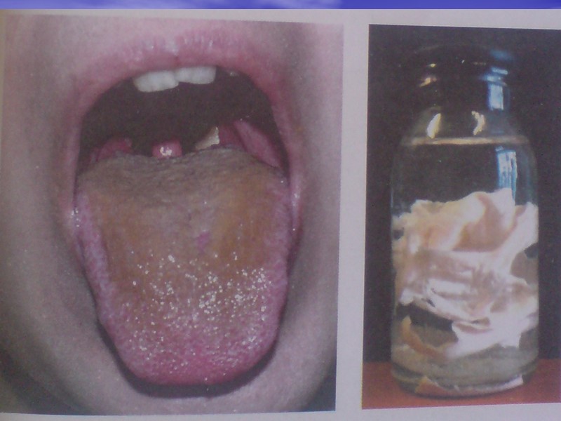 Дифтерийная пленка Появляются и формируются на миндалинах к концу суток, вначале в виде выпота-желе,