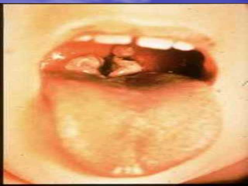 Клиника Инкубационный период от 2 до 10 дней. В зависимости от локализации процесса различают