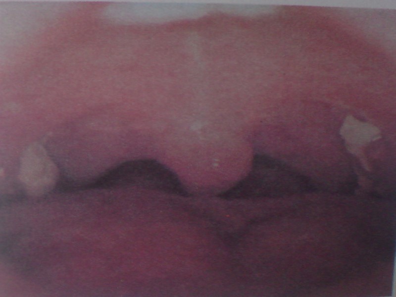 Классификация клинических форм дифтерии Дифтерия ротоглотки: Дифтерия ротоглотки локализованная с катаральным, островчатым и пленчатым