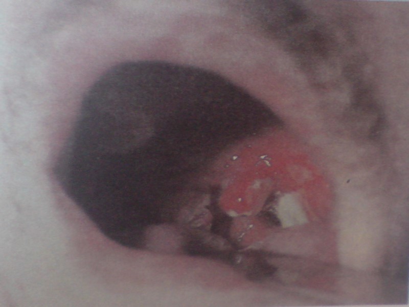 Дифтерия ротоглотки (островчатая) При осмотре зева слизистая оболочка умеренно гиперемирована.  На увеличенных миндалинах