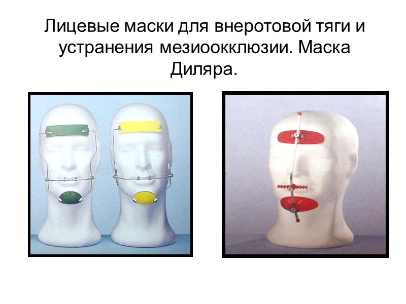 Лицевые и внутриротовые признаки при скелетной (гнатической) форме мезиальной окклюзии.
