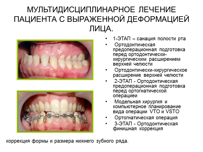 Скелетная форма мезиальной окклюзии. Нейтральный тип роста лицевого скелета