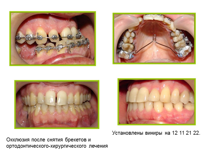 Окклюзия зубных рядов  через 3 месяца лечения.  Окклюзия зубных рядов через 