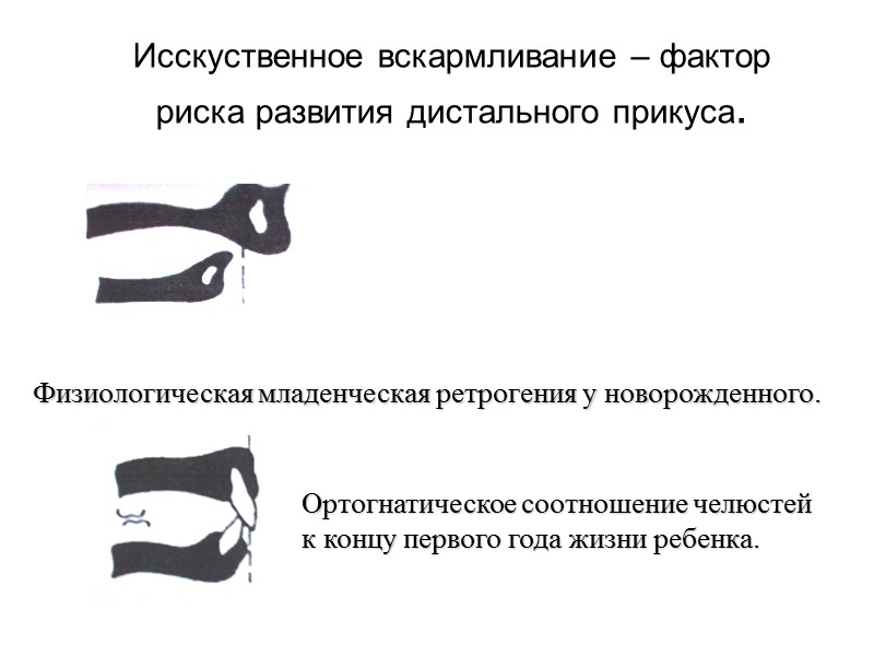 Последовательность лечебных мероприятий при гнатических формах мезиальной окклюзии в периоде постоянного прикуса. Удаление 38