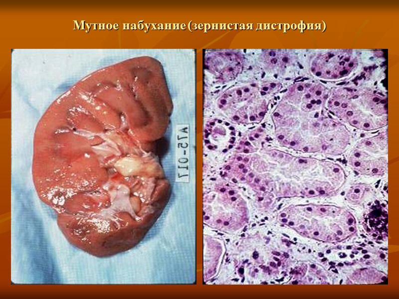 Повреждение клетки, связанное с ишемией и гипоксией Необратимый характер повреждения связан с тяжелым набуханием