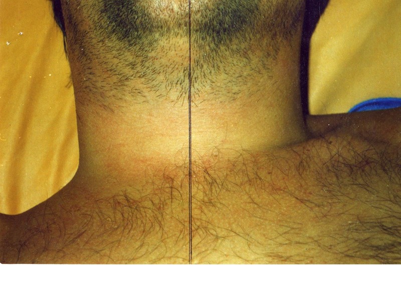 Ранние признаки токсической дифтерии до появления отека  подкожной клетчатки шеи:   