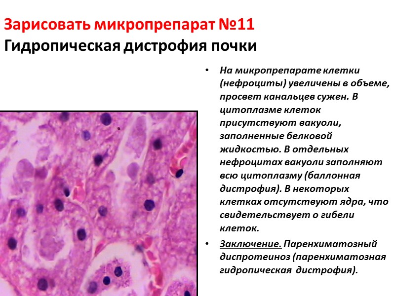 Паренхиматозная жировая дистрофия