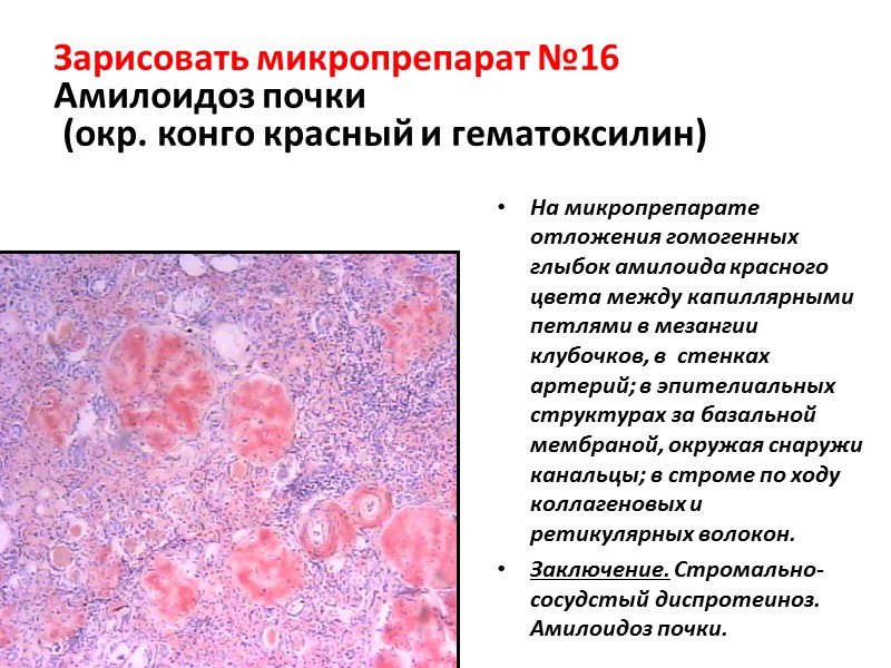 Паренхиматозная жировая дистрофия. Амилоидоз почки микропрепарат Конго красный. Амилоидоз печени патанатомия. Амилоидоз почек патанатомия. Амилоидоз почки микропрепарат.