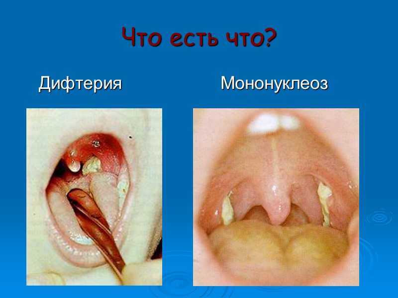 Плашка Элека  Токсигенность возбудителя дифтерии можно оценить методом иммунодиффузии. Полоску фильтровальной бумаги, пропитанную