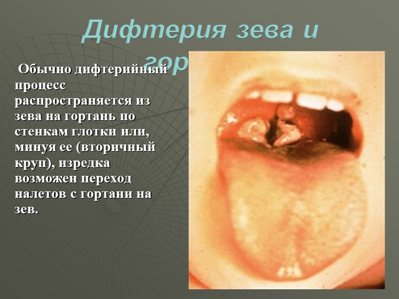 Локализованная дифтерия ротоглотки – наиболее частая форма.  При локализованной форме налеты располагаются только