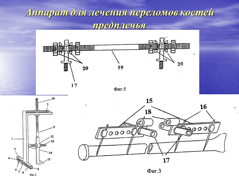 Вытяжение на ортопедическом столе перед наложением аппарата