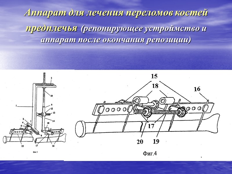 Вытяжение на ортопедическом столе