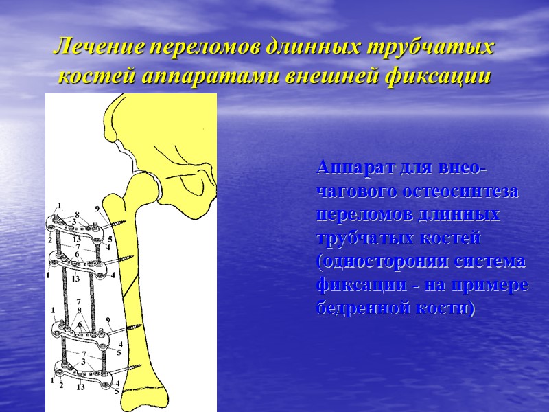 Установка опор с предварительным закосом по расположению фрагментов в боковой проекции