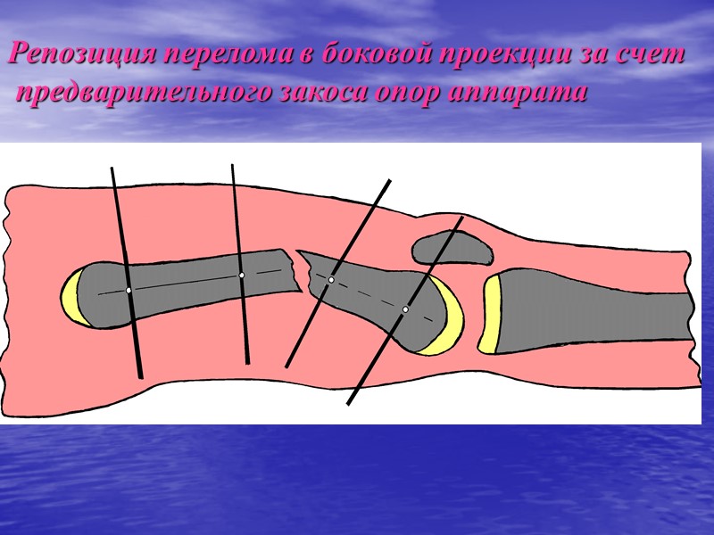 Рентгенография через 2 мес после наложения аппарата