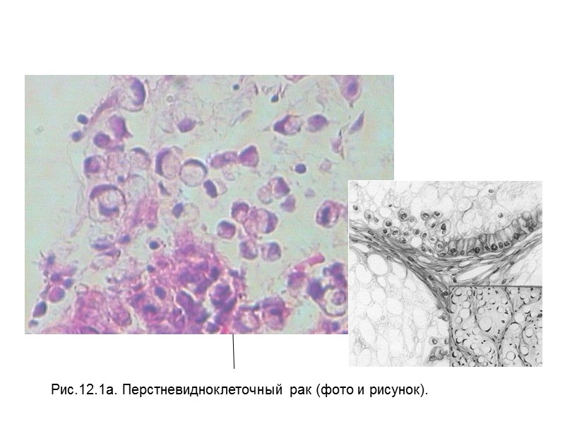 Рис.12.1а. Перстневидноклеточный рак (фото и рисунок).