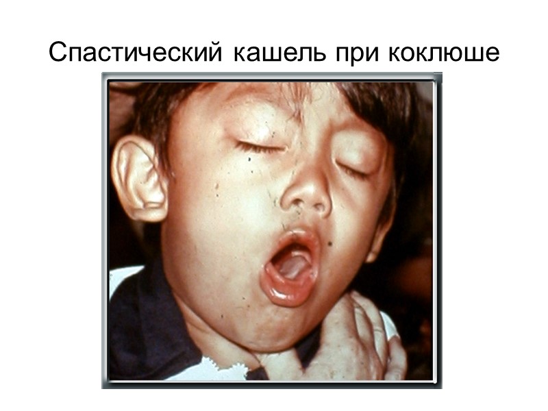 Спастический кашель при коклюше