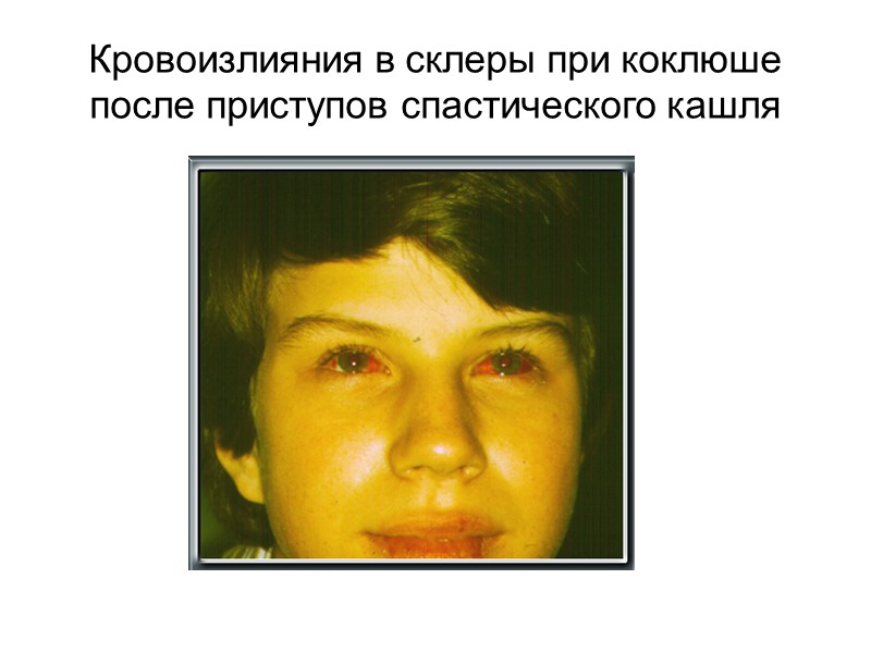 Кровоизлияния в склеры при коклюше после приступов спастического кашля