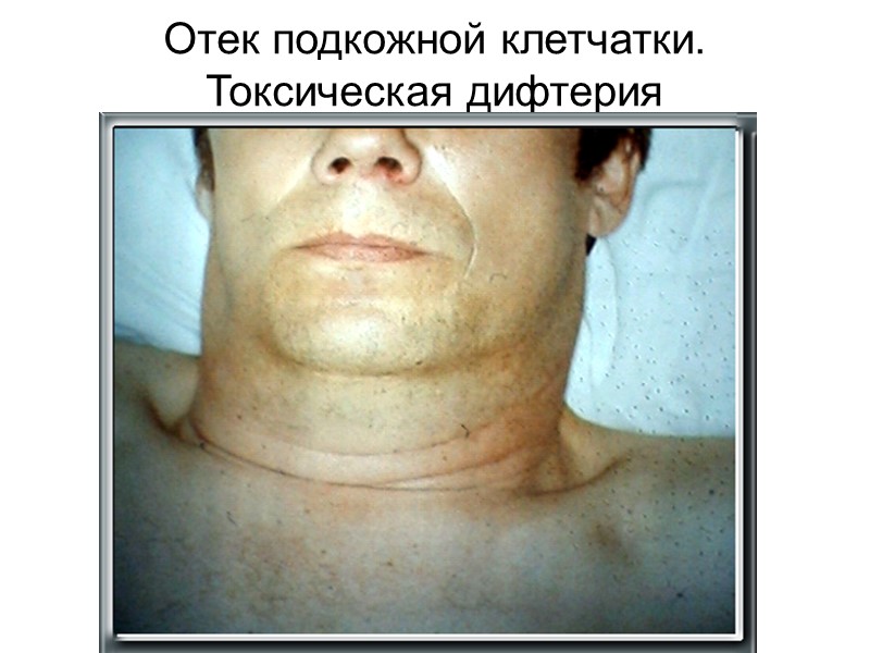 Отек подкожной клетчатки. Токсическая дифтерия