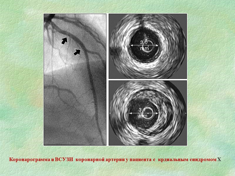 Диагностические критерии кардиального синдрома Х :  • типичная (атипичная) боль в грудной клетке