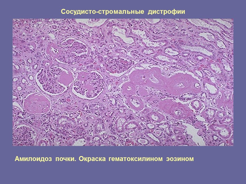 Сосудисто-стромальные дистрофии Фибриноидный некроз стенки артерии при злокачественной гипертензии