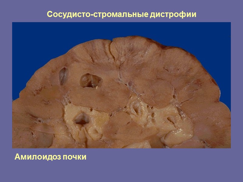 Различные стадии атеросклероза