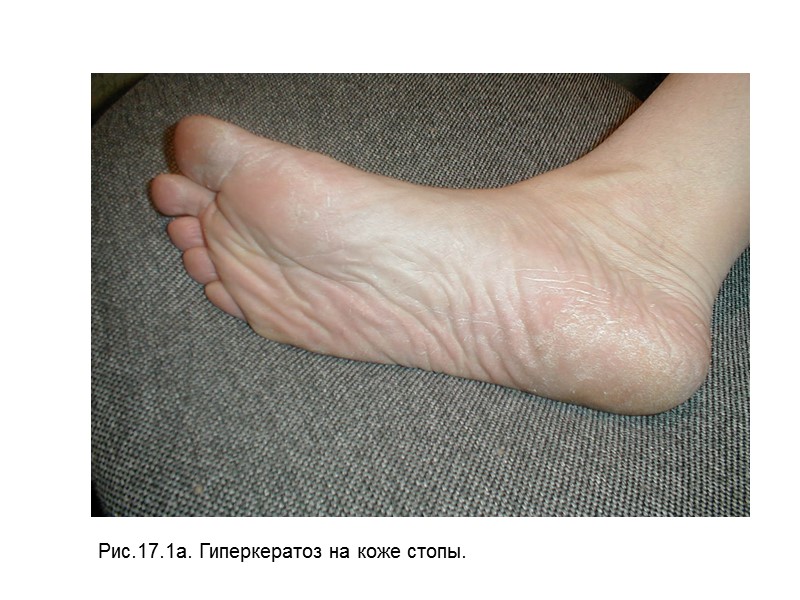 Причины возникновения каллов на коже ног.