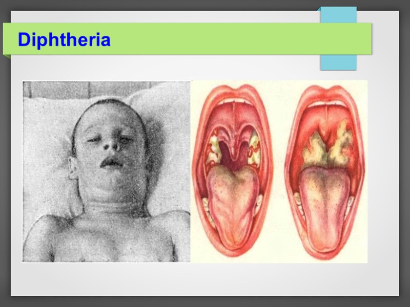 Diphtheria