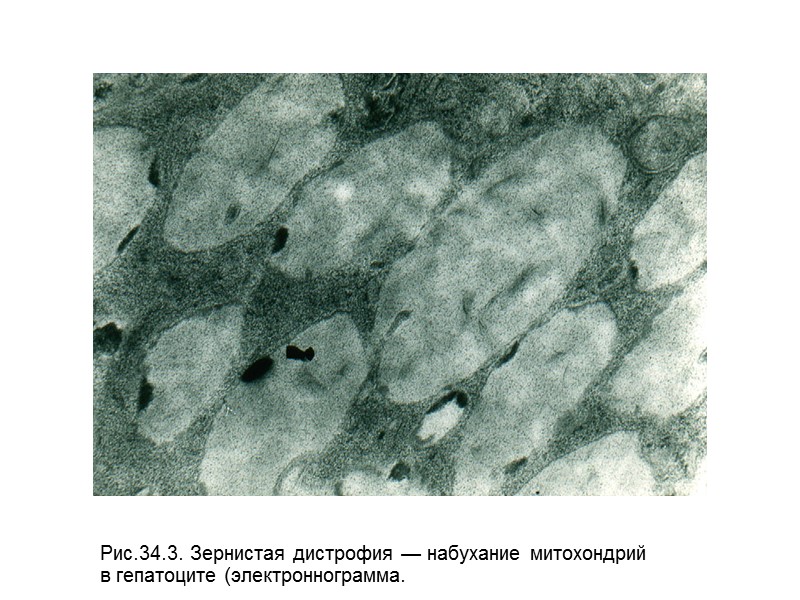 Рис.34.3. Зернистая дистрофия — набухание митохондрий  в гепатоците (электроннограмма.