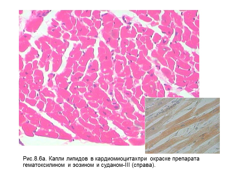 Рис.8.6а. Капли липидов в кардиомиоцитахпри окраске препарата  гематоксилином и эозином и суданом-III (справа).