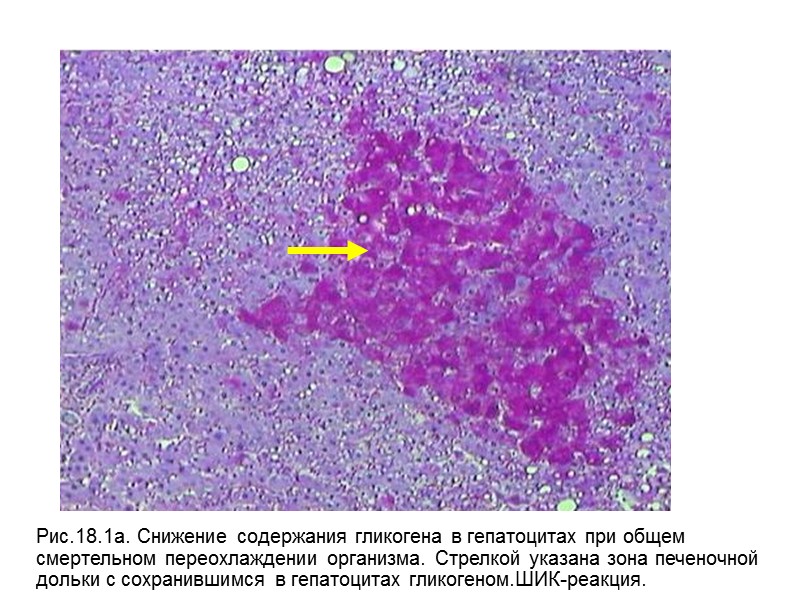 Рис.18.1а. Снижение содержания гликогена в гепатоцитах при общем  смертельном переохлаждении организма. Стрелкой указана